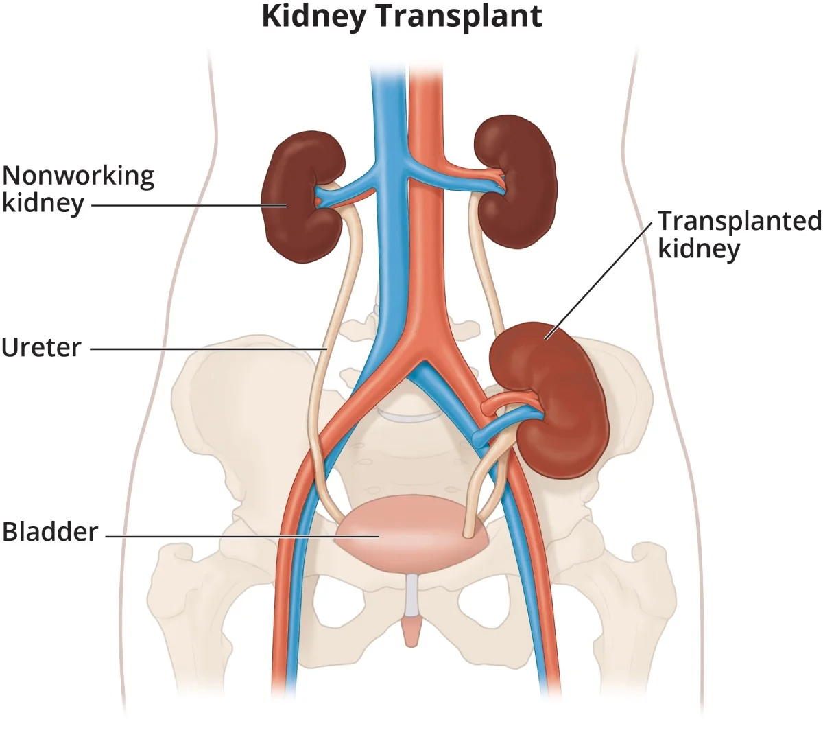 Kidney Transplant
