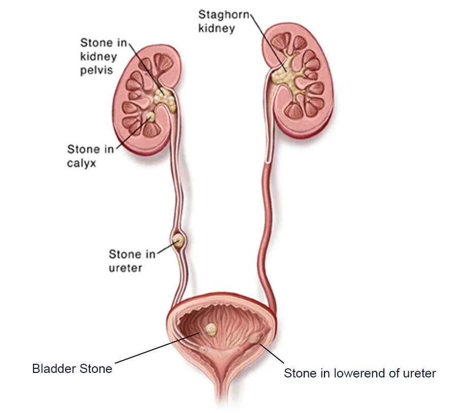 Ureteric Stones